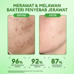 Intense Acne Solution Essence Toner 100 ml